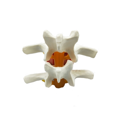 Анатомическая модель грыжи поясничного диска человека Corpo de Hernia-3